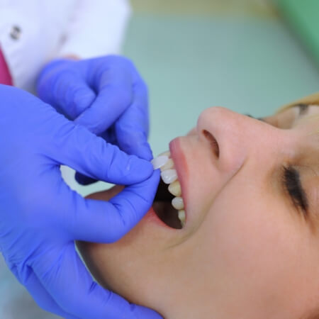 Dental patient's smile compared with cosmetic dental bonding color option