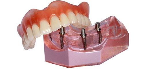 Model implant dentures with a white background