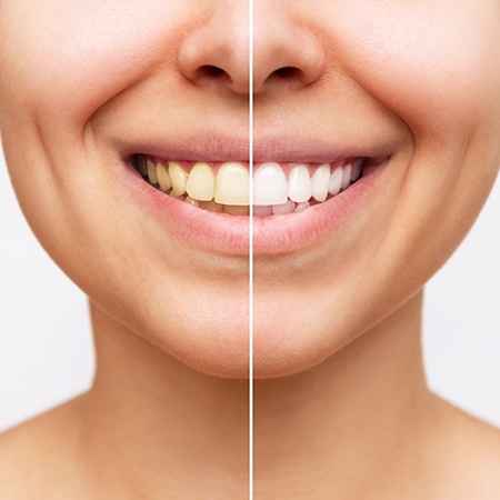 Nose-to-shoulder closeup of woman smiling with teeth half whitened